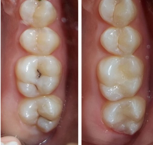 Лечение зубов - врач стоматолог
